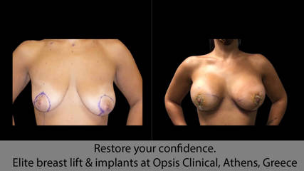 Restore your confidence. Elite breast lift & implants at Opsis Clinical, Athens, Greece