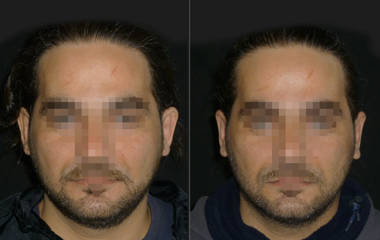 Before and after otoplasty showing correction of protruding ears and balanced ear alignment