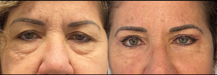 Blepharoplasty 75