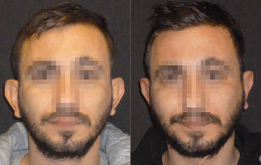 Before and after otoplasty showing correction of protruding ears and improved overall ear symmetry