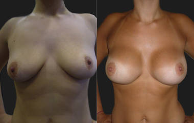 Before and after breast augmentation with silicone implants showing fuller shape and symmetry