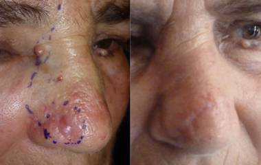 Before and after photos showing nasal skin cancer removal and reconstruction with restored appearance after healing