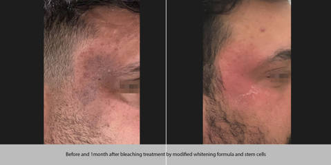 Before and one month after bleaching treatment my modified whitening formula and stem cells