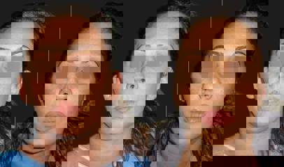 Before and after otoplasty showing improved ear position with corrected earlobe projection