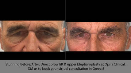 Stunning Before/After: Direct brow lift & upper blepharoplasty at Opsis Clinical. DM us to book your virtual consultation in Greece!