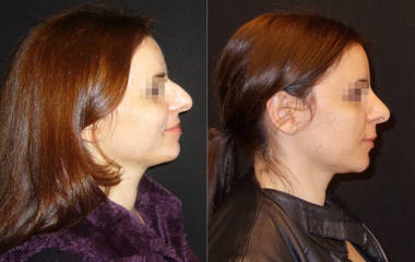 Before and after rhinoplasty side view showing correction of dorsal hump and refined nasal tip