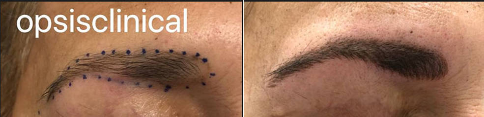 Eyebrow close up before and after micropigmantation showing subtle pigment enhancement