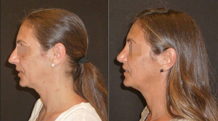 Profile of woman before nd after rhinoplasty and chin enhancement, showing facial balance