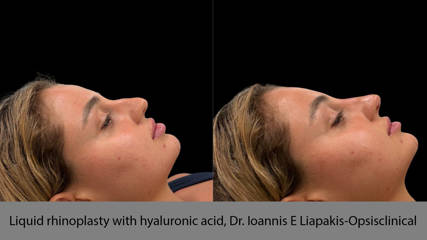 Liquid rhinoplasty with hyaluronic acid, Dr. Ioannis E Liapakis-Opsisclinical