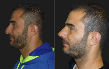 Side view before and after male rhinoplasty showing correction of nasal hump and improved nose contour