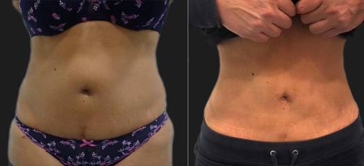 Before and after abdominal liposuction showing toned waistline and smoother abdominal area