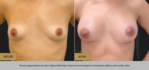 Breast augmentation by 425cc silicone implants in dual plane, before and 4 weeks after