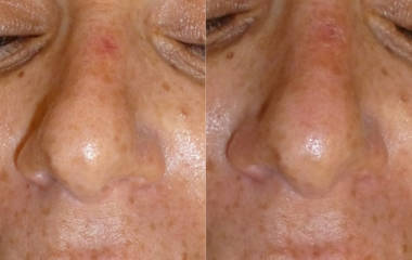Before and after laser spider vein removal treatment on upper nose