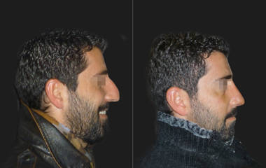 Male side profile before and after rhinoplasty, showing removal of large nasal hump and improved nose projection