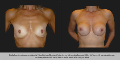 Dual plane breast augmentation by 350cc silicone implants and 150 cc fat and stem cells transfer before and after 4 weeks