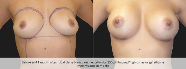 Before and 1 month after, dual plane breast augmentation by 350cc silicone implants and stem cells