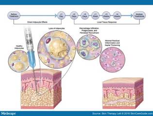 Illustration demonstration deeoxycholic acid destroy fat cells