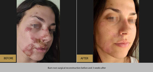 Before and three weeks after non surgical burn reconstruction