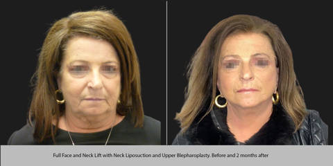 Before and 2 months after full face and neck lift with neck liposuction and upper blepharoplasty