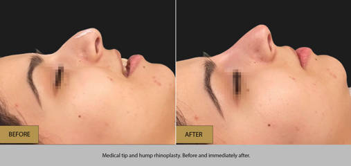 Low angle view before and after medical rhinoplasty for tip refinement and hump reduction