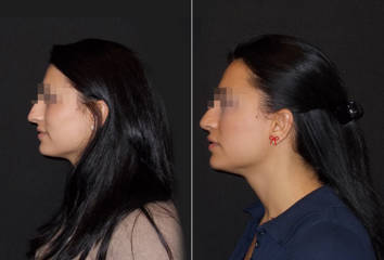 Side profile before and after rhinoplasty showing reduced nasal hump and balanced facial contour