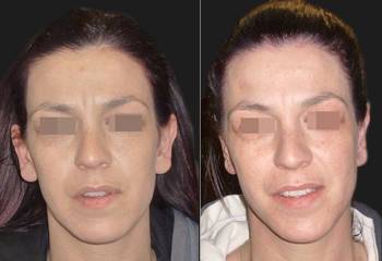 Before and after otoplasty showing correction of ear and earlobe position for balanced appearance