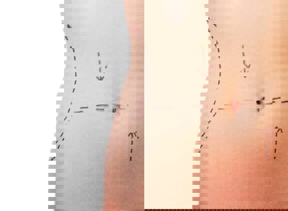 Abdomen marked for high definition abdominoplasty and liposuction planning