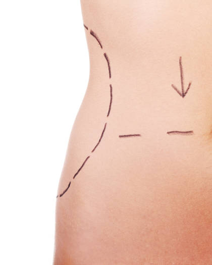 Abdomen marked for high definition abdominoplasty and liposuction planning