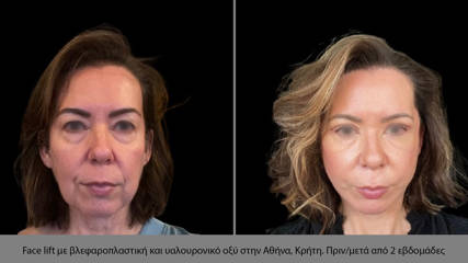 Face Implants 15