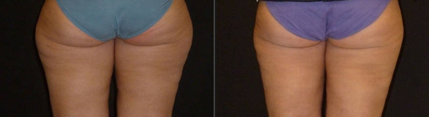 Before and after image showing back view of thighs and buttocks with smoother skin and reduced fat