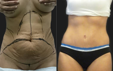 Abdominoplasty before and after showing removal of loose abdominal skin and reconstruction of belly contour