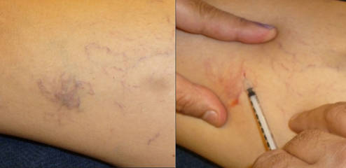 Before and after treatment showing reduced visible veins in a lower limb region 