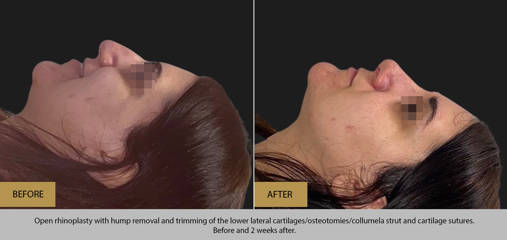 Before and after rhinoplasty with hump removal, lower lateral cartilage trimming, and cartilage sutures