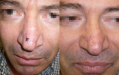 Before and after nasal skin lesion removal showing healing and restored skin texture after treatment
