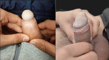 Before and after male intimate surgery demonstrating reconstructive results and improved anatomical appearance