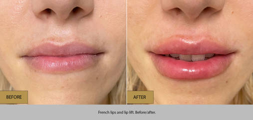 Before and after French lips filler treatment showing softly sculpted lips with balanced volume