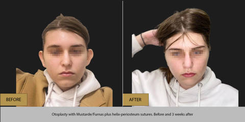 Before and 3 weeks after otoplasty with Mustarde/Furnas and helix periosteum sutures