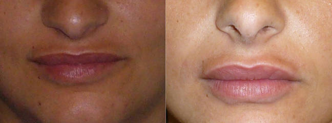Before and after dermal filler treatment showing enhanced cheek and lip volume, smoother facial contours