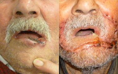 Before and after surgical treatment and reconstruction of a lower lip skin cancer lesion