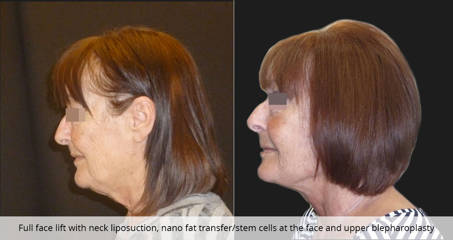 Before and after full facelift with neck liposuction, fat transfer and upper blepharoplasty