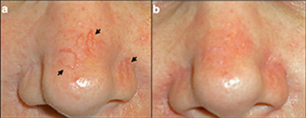 Before and after laser spider vein removal on the nose