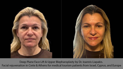 Deep Plane Face Lift & Upper Blepharoplasty by Dr. Ioannis Liapakis. Facial rejuvenation in Crete & Athens for medical tourism patients from Israel, Cyprus, and Europe