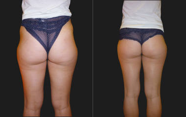 Before and after mesotherapy lipolysis on the buttocks showing smoother contour and decreased fat bulge