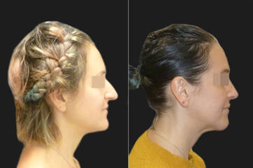 Female side profile before and after rhinoplasty, showing correction of dorsal hump and refined nasal tip