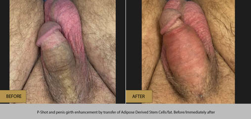 Before and after P-Shot and penile girth enhancement using adipose-derived stem cells and fat transfer