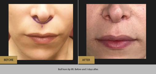 Before and after lip filler treatment showing enhanced volume and balanced lip shape