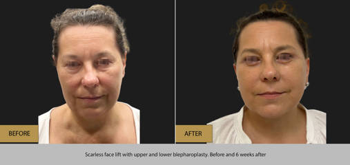 Before and 6 weeks after scarless face lift with upper and lower blepharoplasty