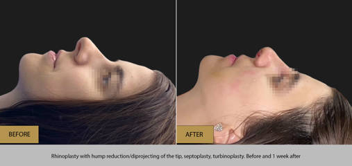 Side profile before and after rhinoplasty with hump removal, tip refinement, septoplasty, and turbinoplasty